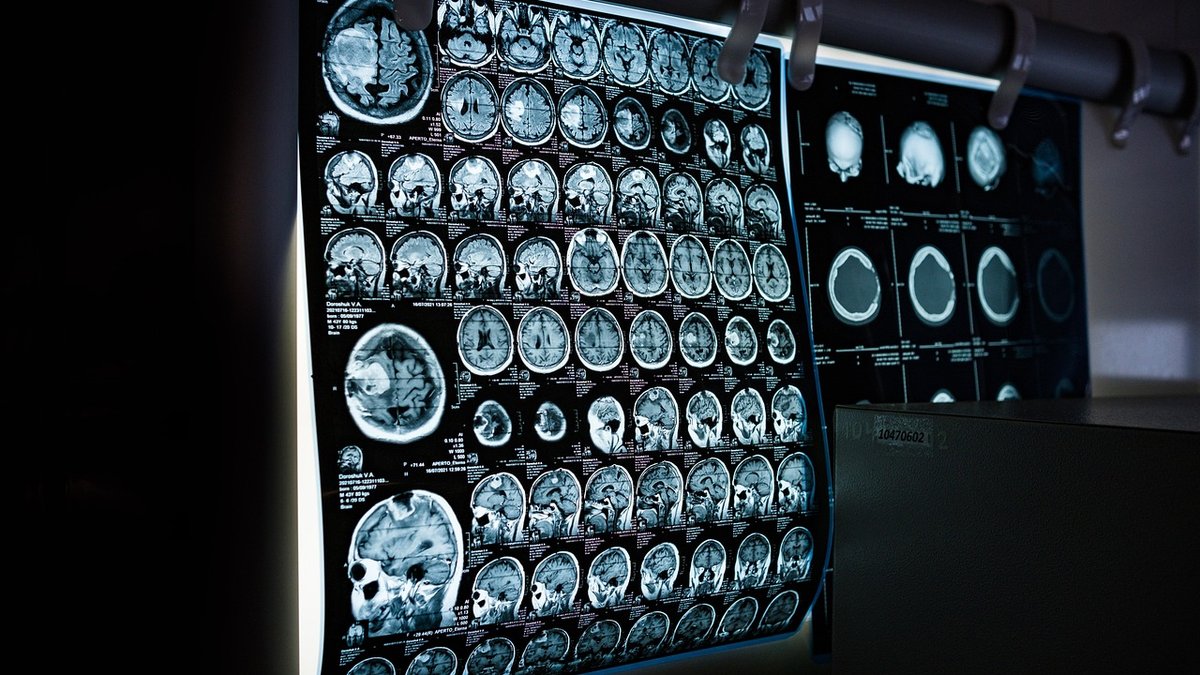TMS Therapy Explained